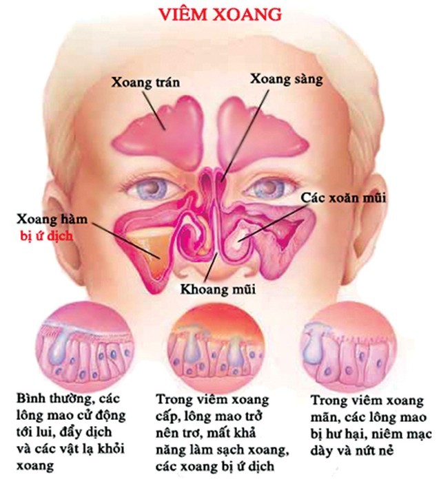 Viêm[-]xoang[-]cấp[-]và[-]thuốc[-]trị