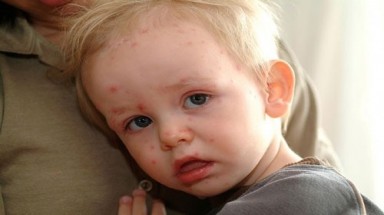 "Mẹo" dân gian trị rôm sảy hiệu quả cho bé trong mùa nắng nóng