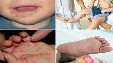  Nâng cao nhận thức của cộng đồng trong phòng chống bệnh tay chân miệng