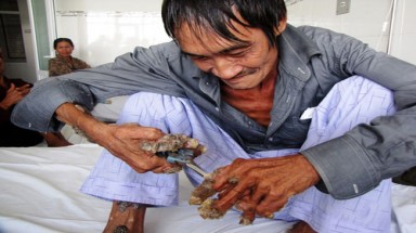 Người bị san hô phủ kín tay chân