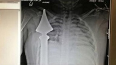  Thoát chết thần kỳ khi bị cọc sắt đâm gần tim