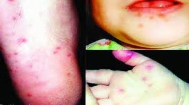  Bình Phước: Thêm một bệnh nhân tử vong do bệnh tay chân miệng 