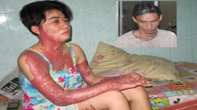    Nỗi đau của người vợ bị chồng tạt xăng thiêu sống