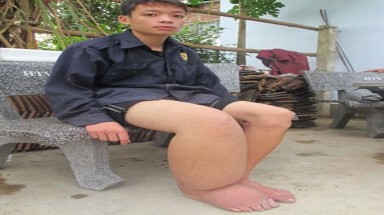 Phẫu thuật thành công cho cậu bé “chân voi”