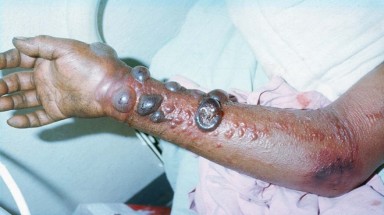  Cách phòng ngừa lây virus nguy hiểm Ebola