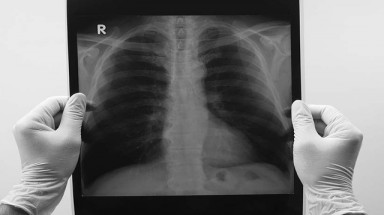 Vì sao không hút thuốc vẫn bị ung thư phổi?
