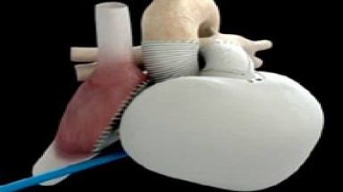 Ca ghép tim nhân tạo đầu tiên trên thế giới