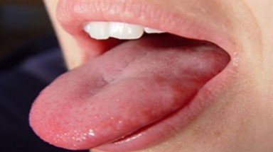  Dấu hiệu nhận biết tình trạng sức khoẻ qua lưỡi